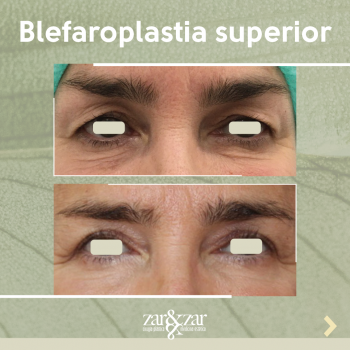 blefaroplastia 4