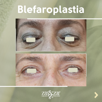 blefaroplastia